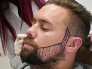 Bart-Augenbrauen-haartransplantation