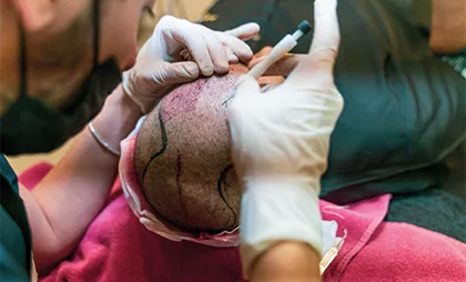 dhi-methode-haartransplantation