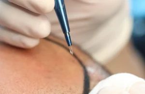 saphir-fue-methode-haartransplantation